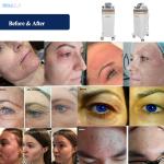 AU Plugs Type 89W Plasma Facial Machine Customized For Spot Removal