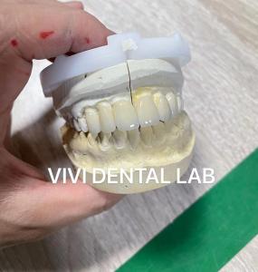 China Wafer Thin Dental Emax Laminate Veneers Translucency Porcelain on sale