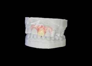 Wholesale Customized Nesbit Flexible Partial Denture for Natural Fit and Longlasting Comfort from china suppliers