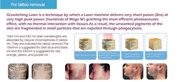 newest pigmentation removal technique best quality ND yag all black tattoo removal device