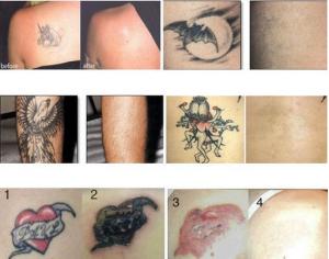 Wholesale 2016 High quality Q switch nd yag tattoo removal laser machine  from china suppliers