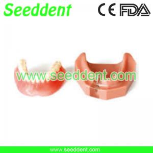 China Overdenture inferior with 2 implants on sale