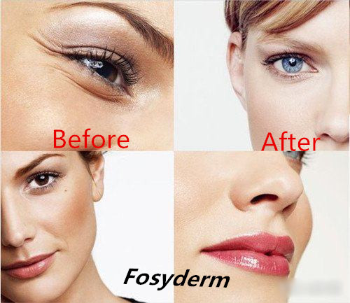 Sexy Lip Augmentation Hyaluronic Acid Dermal Filler No Side Effect Lip Filler