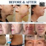Face Lift Anti Aging 5D HIFU Beauty Machine 2 In 1 High Intensity Focused