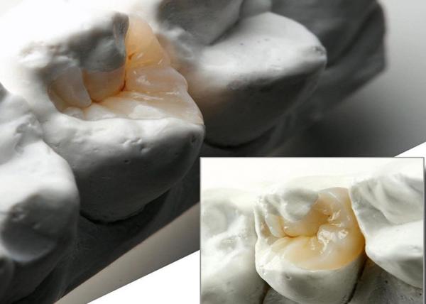 Natural Looking Ceramic Inlays and Onlays for Precise Dental Restoration from