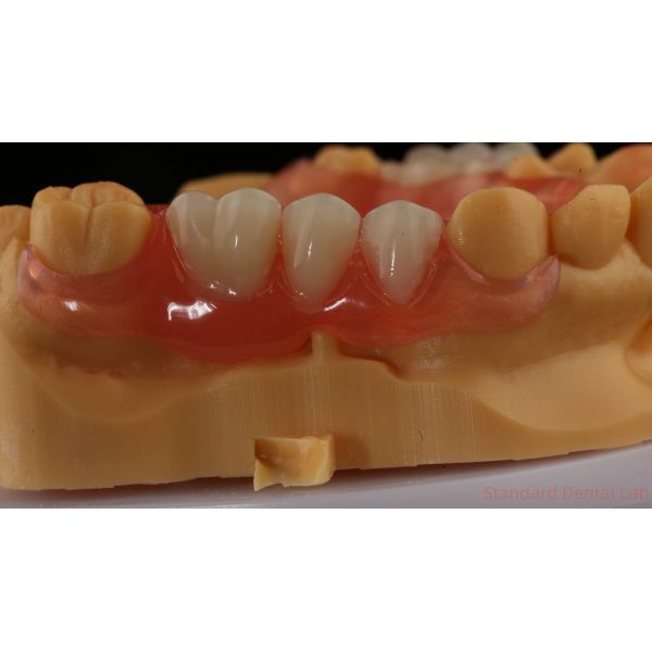 Ace Teeth Pink/Dark TCS Valplast Flexible Partial Dentures for High Esthetics Dental 3D Print Model