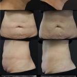 Diode Laser Vascular Removal Machine Endolift Varicose Vein Machine