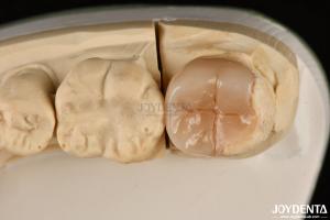 Wholesale Easy Clean Emax Inlays And Onlays Hypoallergenic Biocompatible Dental Restorations from china suppliers