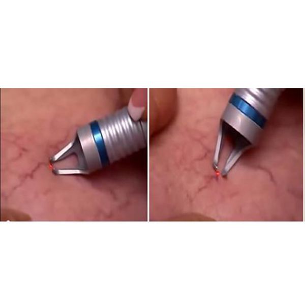 Repeat Pulse Laser Surgery Equipment 2mm Penetration 940nm