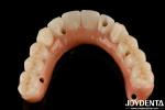 Natural Teeth And Gums Compatible Ti-Bar Zirconia Hybrid Bridge With High